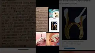 Pulpectomie