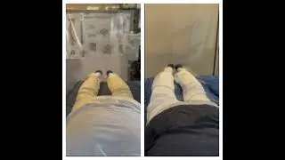 ALS treatment record after 2 weeks