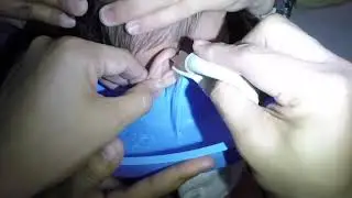 Removing Hard Stuck Earwax From Boy's Ear