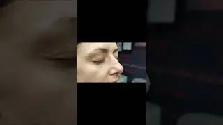 До - после. Токсин + 0.5 мл филлера.