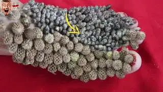 Remove many big ticks from Girl's Foot box # 131