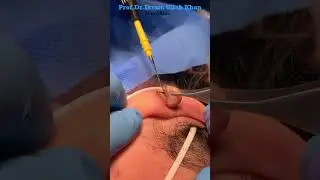 Flatter Skin in Minutes: Ellman RF Magic for Keloid Scars! #keloidscars #lasertreatment