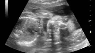 Our baby ultrasound (25 weeks)
