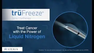 trūFreeze Cryotherapy – Treat Esophageal Cancer with the Power of Liquid Nitrogen
