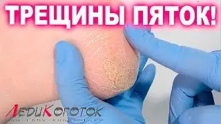 Классический педикюр. Трещины пятки. Как вылечить. Автор Елена Дзык