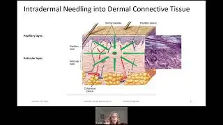Treating Facial Wrinkles with Intradermal Needles