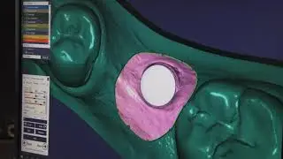 3D Printed model with Implant Analog fitting - DentaFab 3D Printer with model resin