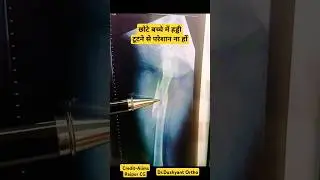 Amazing Fracture Recovery 🔥 बच्चों में हड्डी का तुरंत जुड़ना #fracturerecovery #fracturetreatment
