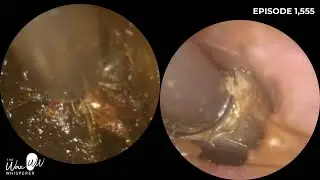 1,555 - 2 Ear Wax Removals from Narrow & Hairy Ear Canals