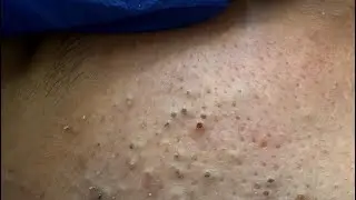 ASMR Facial Care: The Ultimate Blackhead Removal and Pimple Treatment!