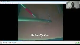 How to tie laparoscopic intracorporal cinch knot-the sliding square knot?