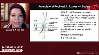 Access and Closure in Endovascular Therapy: Radial, Femoral, and Beyond