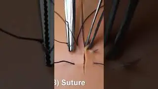 188.Figure of 8 suture 