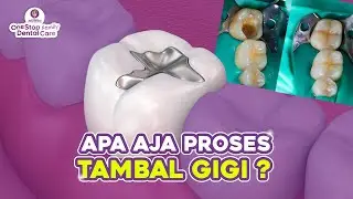 PROSES TAMBAL GIGI DAN KENAPA GIGI LUBANG HARUS DITAMBAL ?