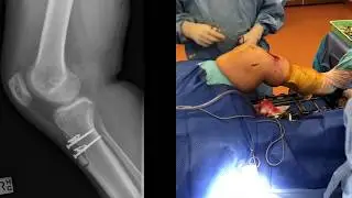 Tibial Tubercle Transfer and Medial Patello-Femoral Ligament Reconstruction