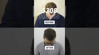 FUE hair transplant - result after 12 months #recedinghairline #fuehairtransplant