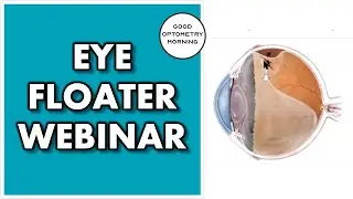 FLOATERS IN MY EYES: youtube eye doctor webinar on eye flashes & floaters