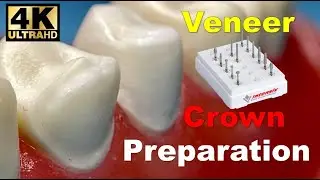 Veneer and Crown Prep Step-by-Step