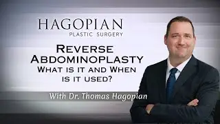 Reverse Abdominoplasty: What is it and When is it used?