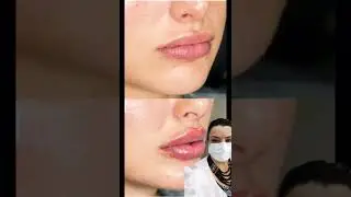 preenchimento labial #beleza #subscribe