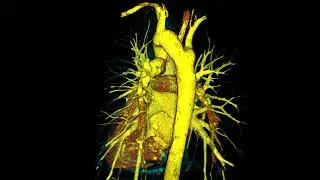 Kommerell's diverticulum  A rare aortic arch anomaly