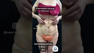 Жесткое похудение и после избыток кожи, скоро покажу результат после пластики тела #бодилифт