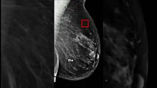 AI Model Can predict Breast Cancer #shorts #ai