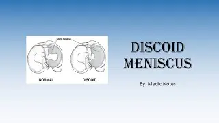 Discoid meniscus - signs and symptoms, imaging, treatment