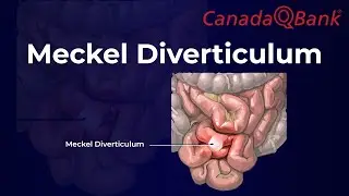 Meckel Diverticulum Explained | Rule of 2s, Diagnosis & Management | CanadaQBank
