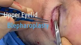Explaining Upper Eyelid Blepharoplasty + [Intraoperative Footage]