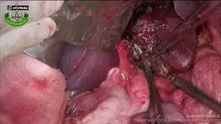Isolated caudate lobe lobectomy