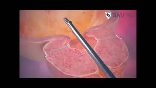Urolift in Bangalore