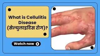 Disease in news Important for BPSC UPSC | Cellulitis Disease | Current Affairs for #upsc #bpsc