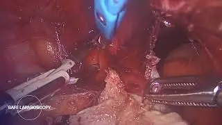 Sub.T.L.H. for a Large Uterus with Previous Myomectomies | Safe Laparoscopy