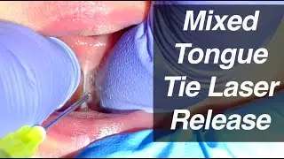 Mixed Tongue Tie Laser Release