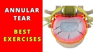 What is Annular Tear? What is the best exercise to maximise your healing and reduce your pain