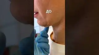 «Жидкие нити». Восстановление упругости кожи и коллагена. #shorts #aesthefill