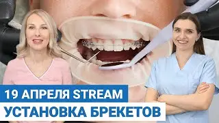 Установка брекетов – трансляция из кабинета