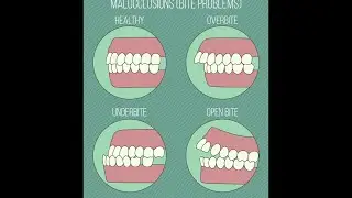 Different Types of Malocclusions