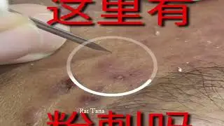 Acne treatment   acne removal   acne blackheads whiteheads removal 9002