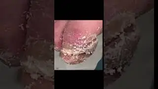 Regular Diabetic Footcare Prevents Major Problems