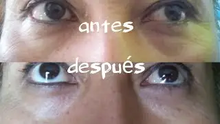 DESAPARECE bolsas de los ojos con UVA?! - Probando cosas