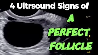 A Perfect Follicle | 4 Ultrasound Signs - of Good Follicle for Easy Conceiving