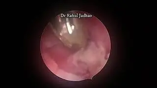 CU  T Removal with suture loop in office with hysteroscopic guidance