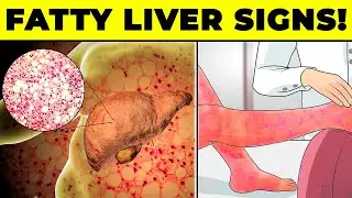 Unlocking the Secrets: Recognizing Silent Signs of Fatty Liver You Should Never Ignore!