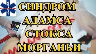 Синдром Морганьи - Адамса - Стокса
