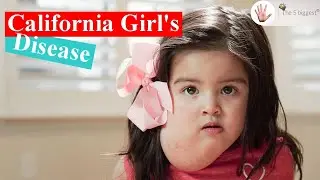 Weird Diseases: California Girl's Disease! ~ Body Bizarre!