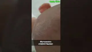 OQ DOG'LARNI DAVOSI TOPILDI ОК ДОГЛАРНИ ДАВОСИ ТОПИЛДИ ВИТИЛИГО КАСАЛЛИГИНИ ДАВОЛАШ УЧУН ТАФСИЯЛАР