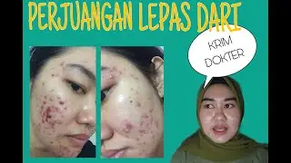 MY ACNE STORY [PART I] | SUSAHNYA LEPAS DARI KRIM DOKTER, SETELAH LEPAS LANGSUNG BREAKOUT