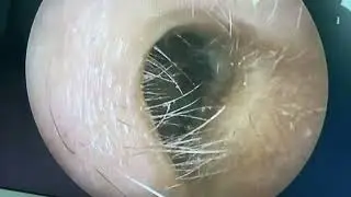 #Chronic otitis media